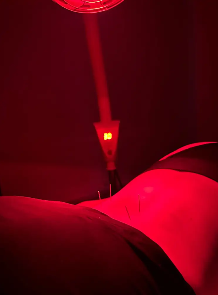 A person lying face down under red lighting with acupuncture needles placed along their back. A digital display nearby shows the number 30, suggesting heat or time setting. The atmosphere is calm and therapeutic.