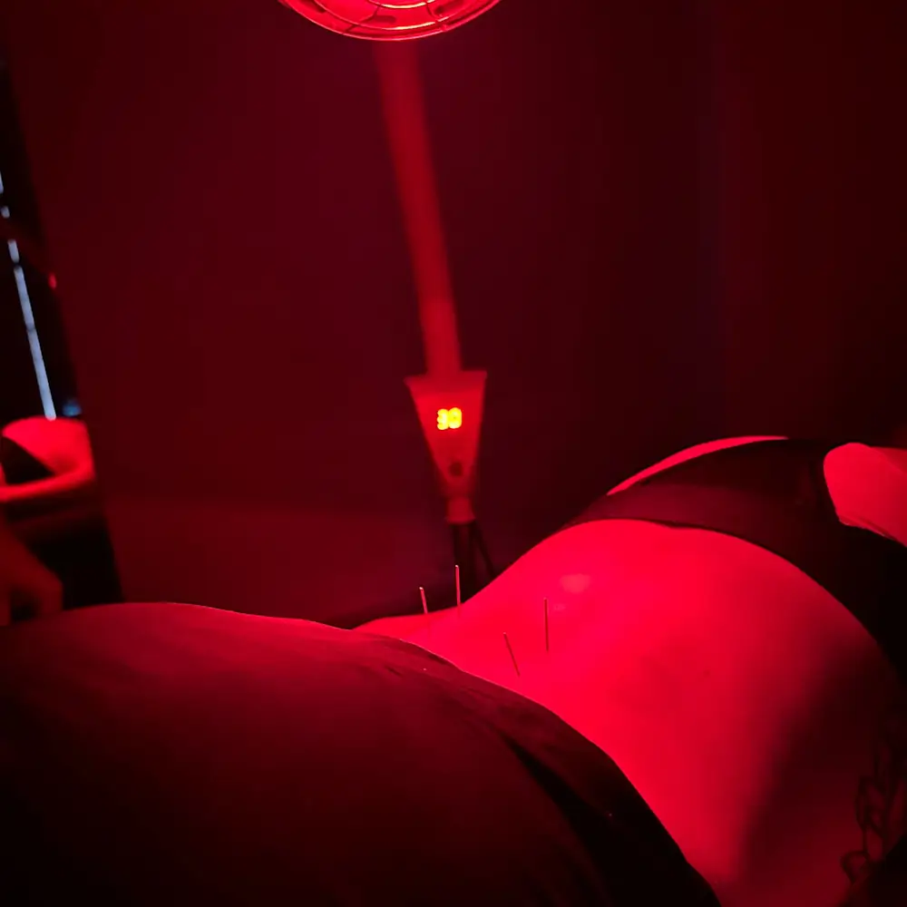 A person lying on their stomach, receiving acupuncture treatment under red lighting. Several needles are inserted into the skin on the back, with a heating lamp nearby displaying the number 38.