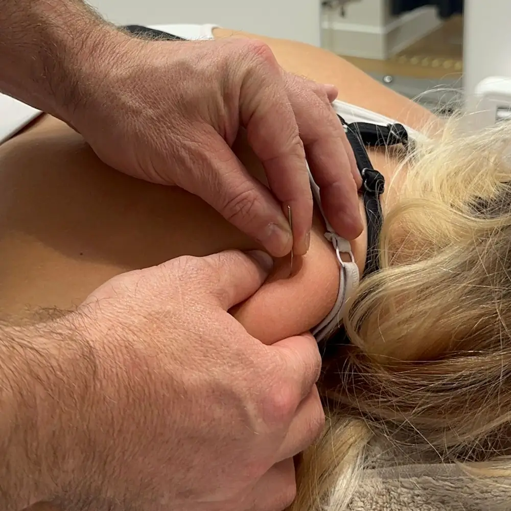 A person undergoing acupuncture, akin to physiotherapy, with two needles delicately inserted into their upper back near the shoulder while lying down. The practitioner's hands meticulously adjust the needles. The patient, who has blonde hair, is in a clinical setting.