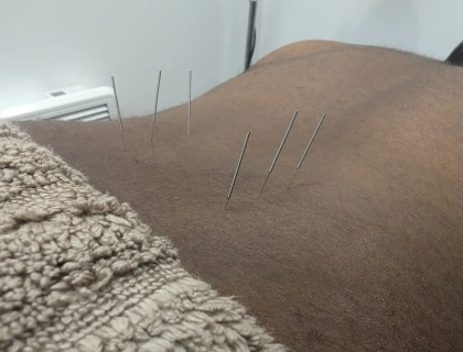 Acupuncture needles inserted into the back of a person who is lying down. A textured beige cloth partially covers the lower back. The setting appears to be a treatment room.