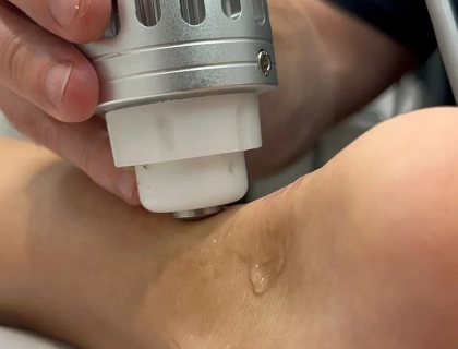 Close-up of a person receiving a laser treatment on their bare shoulder. A hand holds a metal handheld device with a white tip, emitting light over the shoulder area. A shiny gel is applied to the skin, and the background is blurred.